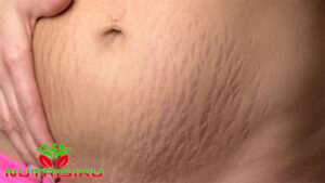 Cara Menghilangkan Stretch Mark secara Alami